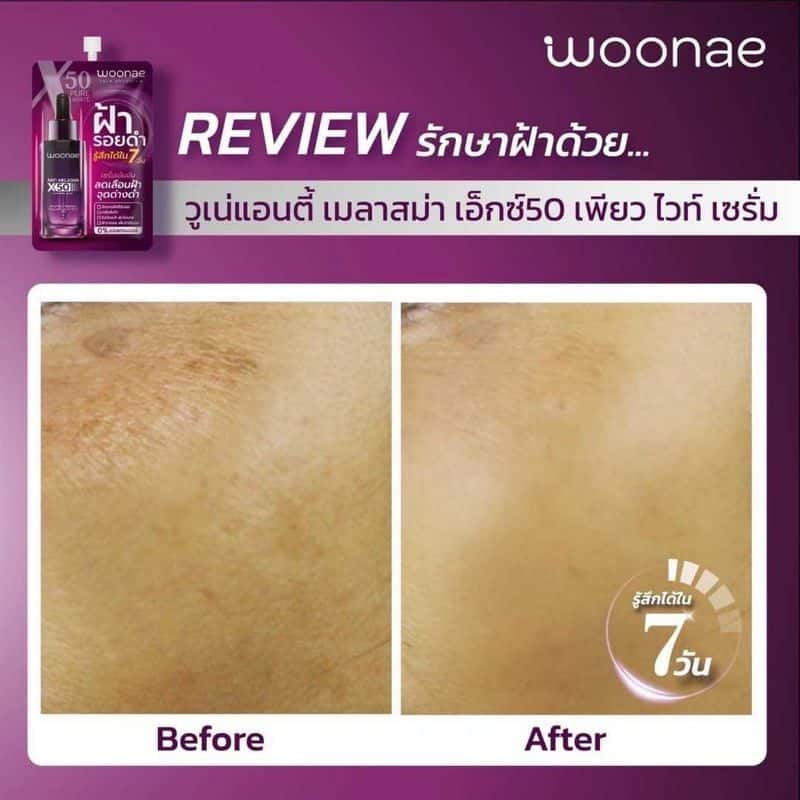 Woonae เซรั่มบำรุงผิวหน้า Anti Melasma X50 Pure White Serum 10กรัม (6ซอง) title =Woonae เซรั่มบำรุงผิวหน้า Anti Melasma X50 Pure White Serum 10กรัม (6ซอง)